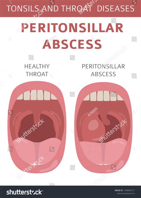 Tonsillar Abscess