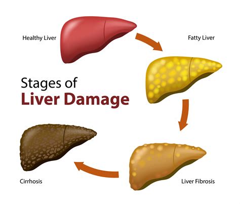 Causes of Fatty Liver and Its Treatment - Sanjana Shenoy