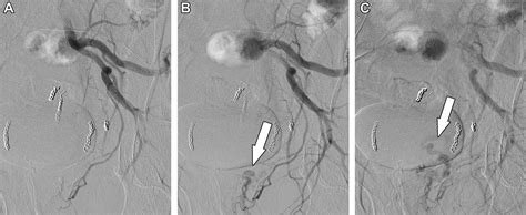 Rectal Artery Embolization for Hemorrhoidal Disease: Anatomy, Evaluation, and Treatment ...