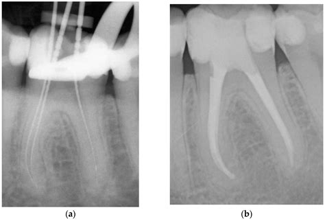 Endodontic Outcome of Root Canal Treatment Using Different Obturation Techniques: A Clinical Study
