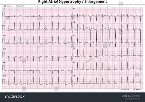 Right Atrial Enlargement On Ecg