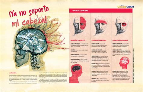 INFOGRAFÍA: Diferentes tipos de dolor de cabeza - Ciencia UNAM