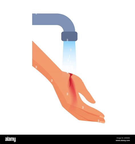 First aid for hand injury, water cleaning of patients human arm with wound vector illustration ...