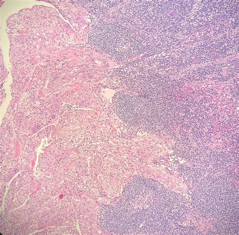 55 y/o female. Pelvic lymph node dissection for endometroid ...