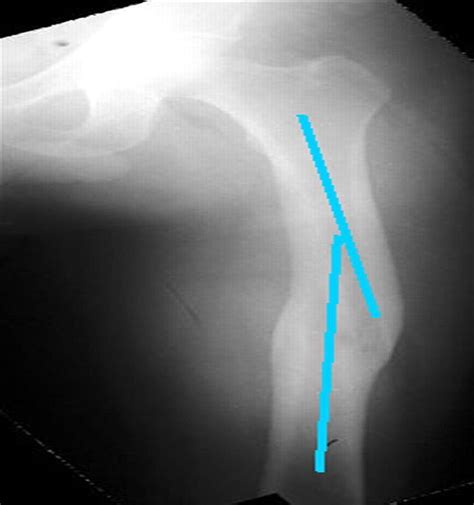 Image result for Clamshell Procedure