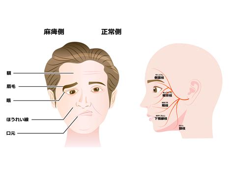 末梢性顔面神経麻痺と再生医療 - 奈良県香芝市の内科・呼吸器内科・美容皮膚科 ｜ ノアクリニック ｜ NOA CLINIC