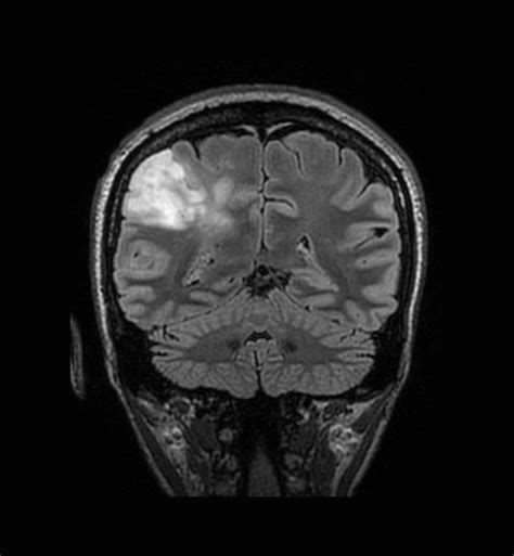 Understanding Brain Tumors