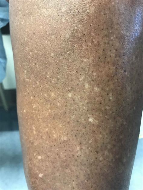 Idiopathic guttate hypomelanosis causes, symptoms, diagnosis & treatment