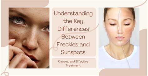 Understanding the Key Differences Between Freckles and Sunspots ...