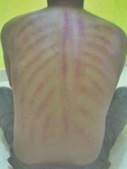 Kerokan - JungleKey.in Image