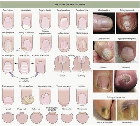 Pin by Syrine Zena on Remède in 2025 | Nail diseases and disorders, Nail disorders, How to grow ...