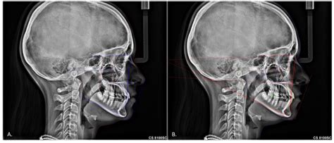 Comparing a Fully Automated Cephalometric Tracing Method to a Manual ...