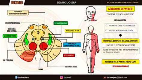 Image result for Contralateral Hemisphere