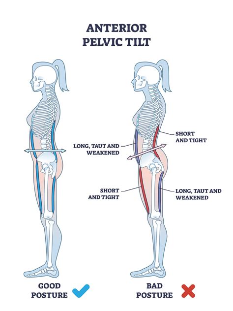 How To Fix Anterior Pelvic Tilt Posture - Chatfield Family & Sports ...