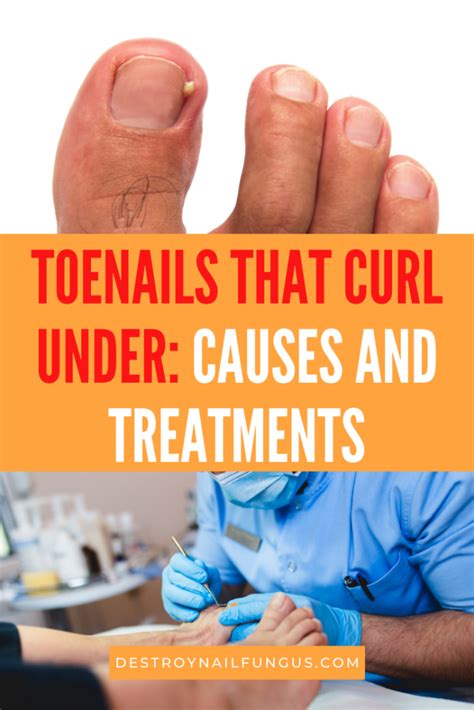 Curled Toenails Fix 的图像结果