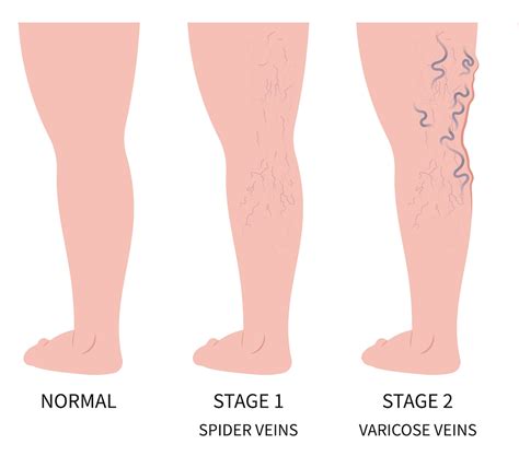 Spider Veins vs Varicose Veins | Venia MD in CDA