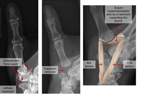 What Is A Bone Spur In Your Thumb at Coleman Stevens blog