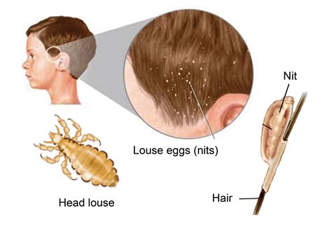 How to treat Head lice with Tea Tree Oil - Yabibo