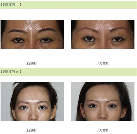 切眉手术前后照片对比，杭州雕眉价格 - 眉毛种植 - 炫美网