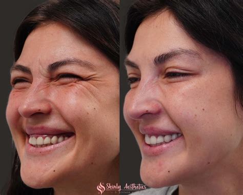 Botox Before and After Results - Everything You Need to See & Know