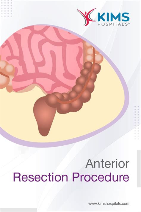 Image result for Apr Resection Surgery