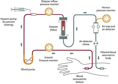 Hemodialysis - Procedure, Hemodialysis Side Effects