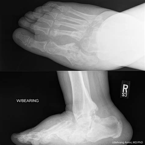 Roentgen Ray Reader: Neuropathic (Charcot) Arthropathy