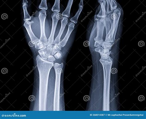 X-ray Image of Wrist Joint for Diagnosis Rheumatoid Arthritis Stock ...