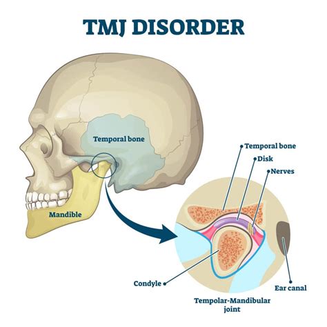 What Does Tmj Stand For