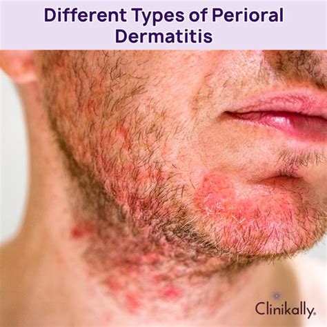 Your Eczema Cream Might Be Causing You Perioral Dermatitis