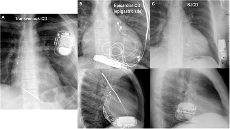 Continuous Cardiac Monitoring Defib 的图像结果