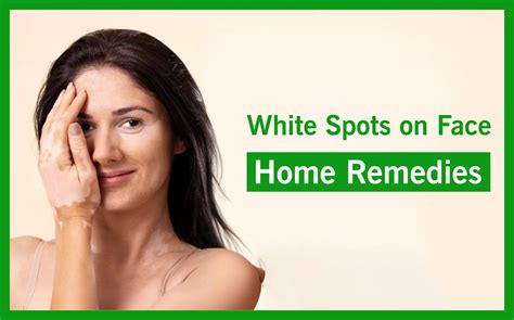 White Spots on Face Home Remedies