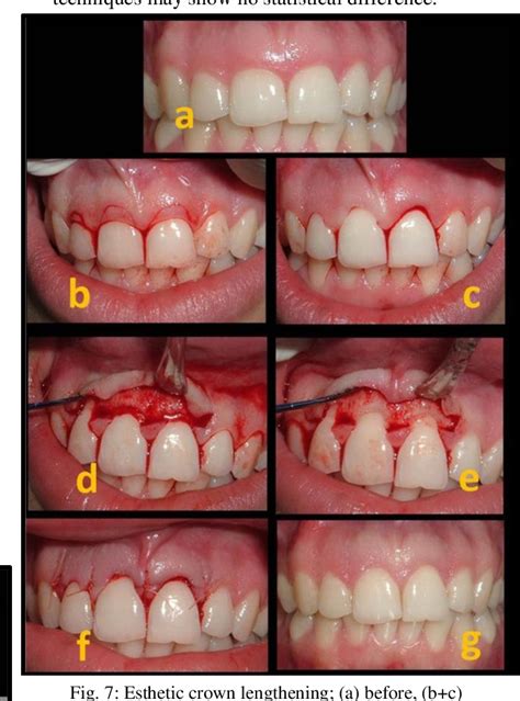 Image result for Contralateral Teeth