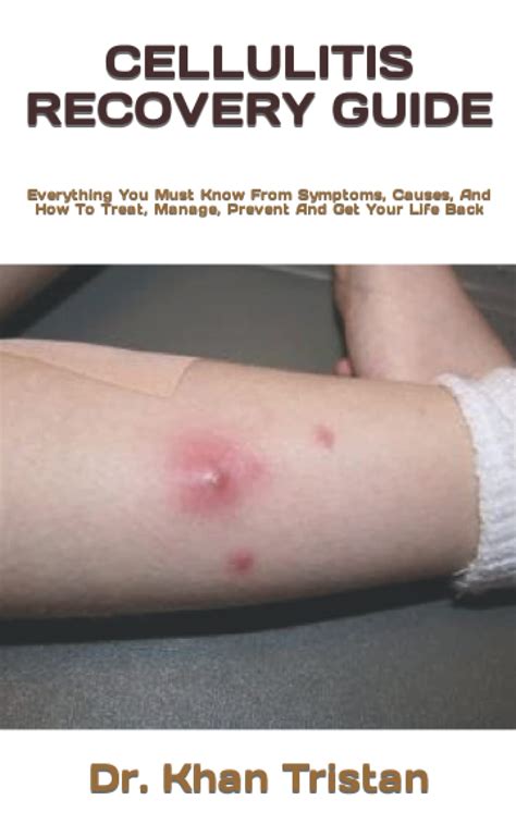 Buy CELLULITIS RECOVERY GUIDE: Everything You Must Know From Symptoms ...