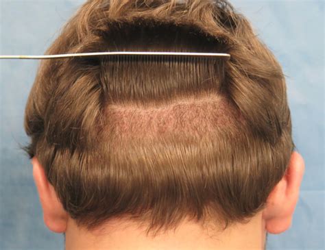 FUE Hair Transplant 101 : All you need to know