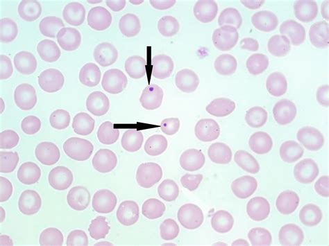Howell-Jolly Bodies – A Laboratory Guide to Clinical Hematology