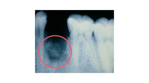 Image result for Tooth Extraction Dry Socket