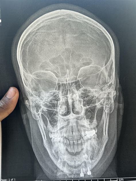 Hello all, i have mild sleep apnea and some jaw issues. I have had a ...