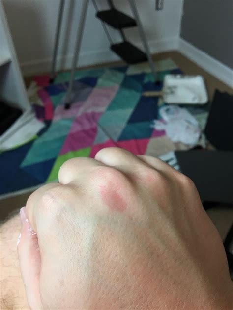 Burst Blood Vessel In Finger Images Blood Blisters: Causes, Diagnosis,