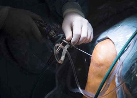 Knee Arthroscopy | Dr. Prasoon Shamshery | Dr Prasoon Kant Shamshery