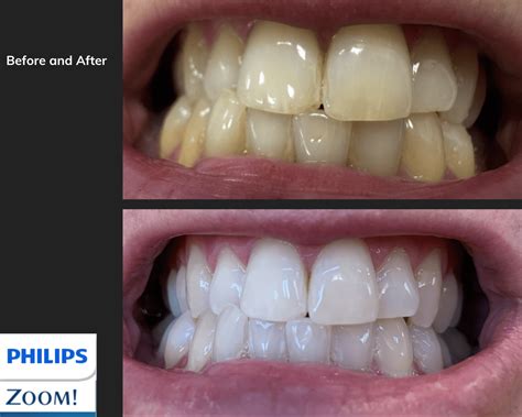 Teeth Whitening
