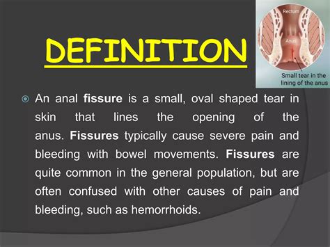 Anal fissures | PPTX
