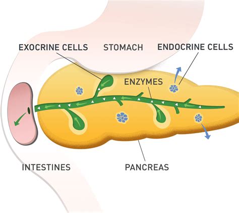 What Is EPI (Exocrine Pancreatic Insufficiency)?