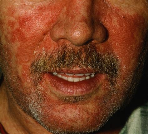 seborrheic_dermatitis_rd
