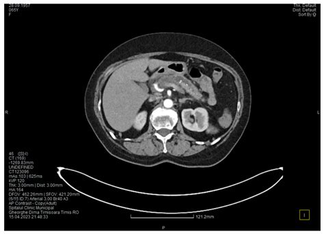 Pancreaticoduodenectomy with Anatomical Vascular Variant in Groove ...