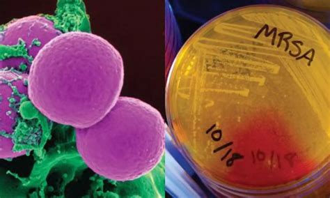 Oral minocycline plus rifampicin as good as oral linezolid for treating ...