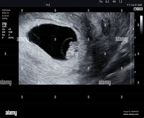 Embryo at 7 weeks, ultrasound scan Stock Photo - Alamy