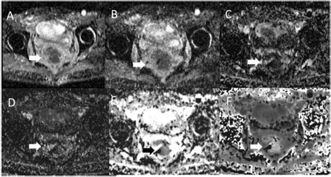 Intravoxel Incoherent Motion Model of Diffusion Weighted Imaging and ...