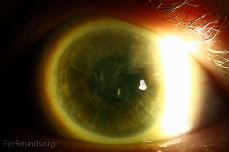 Atlas Entry - Limbal stem cell deficiency