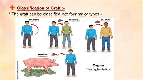 transplantation_and_rejection , classification of graft , rejection types and mechanism | PPT